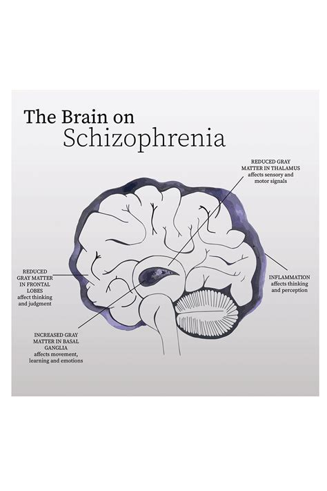 Schizophrenic Brain Diagram Brain Digital Printable Medical Etsy