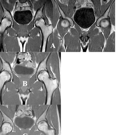 PDF A Steroid Induced Bilateral Avascular Necrosis Of The Femoral