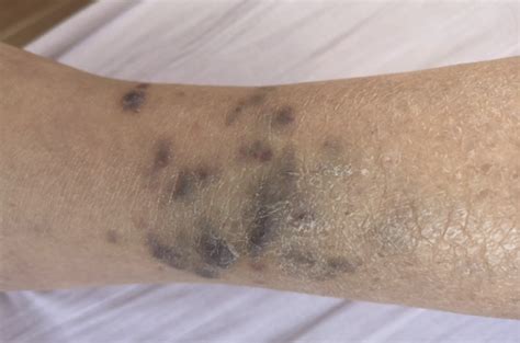 Cutaneous Kaposis Sarcoma The Bmj