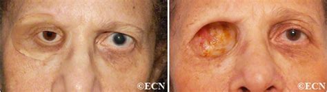 Exenteration After Images » New York Eye Cancer Center