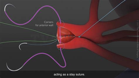 Side To Side Arterioplasty For Renal Arteries On Donor Kidney Graft