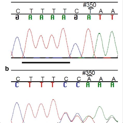 The novel germline sequence alteration c.2709 + 122delT in EMSY. a ... 