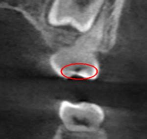 Cbct Scan For Cavities Oral Radiology Toronto