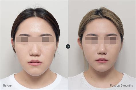 이유구강악안면외과치과의원 수술후기전후 Beforeandafter