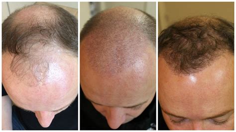 Micro Greffes De Cheveux Dr Thierry Fontaine Dermatologue