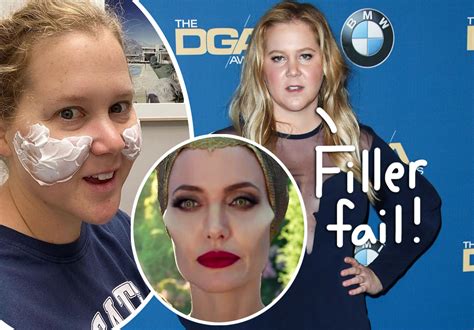 Amy Schumer Got Botched Plastic Surgery & IMMEDIATELY Undid It: 'I ...