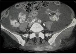 Learningradiology Acute Abdominal Emergencies