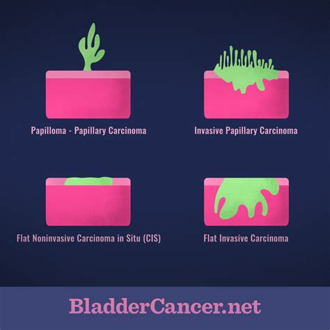 Understanding The Different Types And Forms Of Bladder Cancer