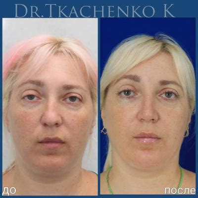 Риносептопластика (пластика носа) | Dr. Tkachenko_K