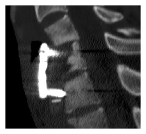 A B And C Postoperative CT Scan Demonstrating A Good