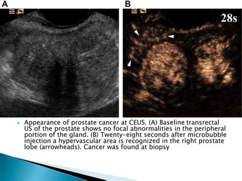 Contrast Enhanced Ultrasound Ppt