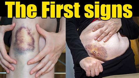 What Are The First Signs Of A Blood Clot Warning Signs Of A Blood Clot