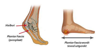 Wat Is Hielspoor Oorzaken Symptomen En De Oplossing Voor Hielspoor
