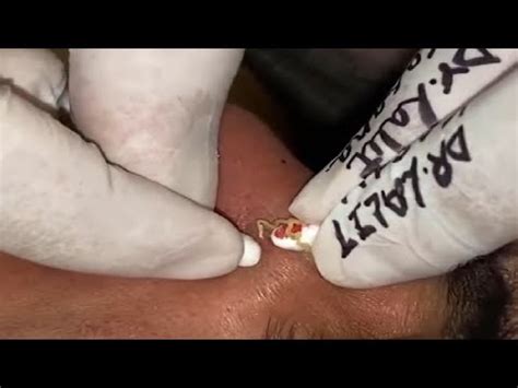 Deep BLACKHEAD Removal By Dr Lalit Kasana New Video 02 YouTube