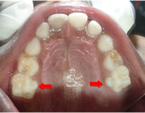 Dental Anatomic Variations In Primary Dentition A Case Series