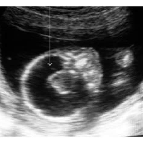 (a) T2 weighted image in the sagittal plane showing fused thalami and... | Download Scientific ...