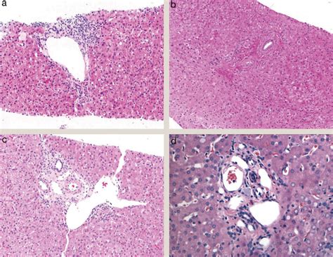 Diagnosis And Classification Of Vascular Liver Disorders Diagnostic