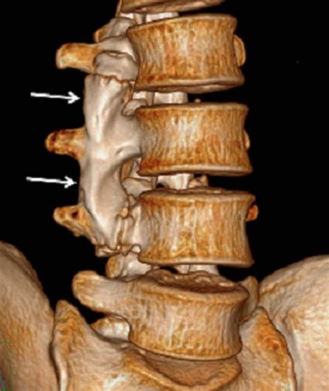 Traumatic Osseous Bridging Of Lumbar Transverse Processes Causing Low