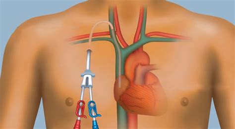 Colocaci N De Cat Ter De Hemodi Lisis
