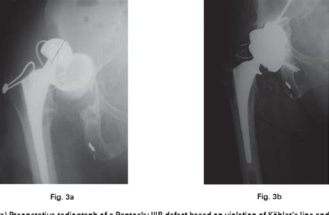 Figure 3 From Two‐centre Radiological Survivorship Of Acetabular Distraction Technique For