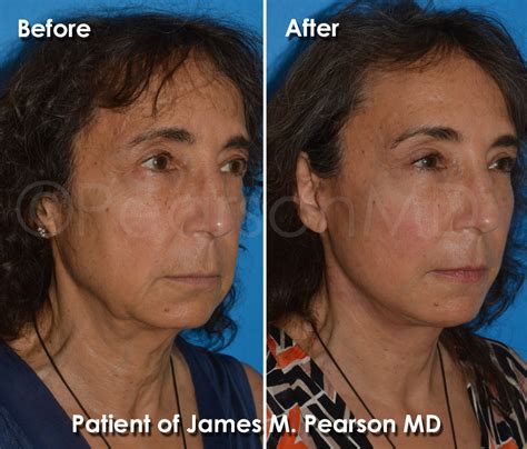 Before After Photos Photo Gallery Dr James Pearson Facial Plastic