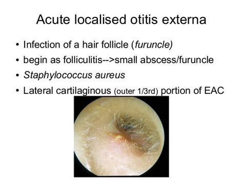 Otitis Externa