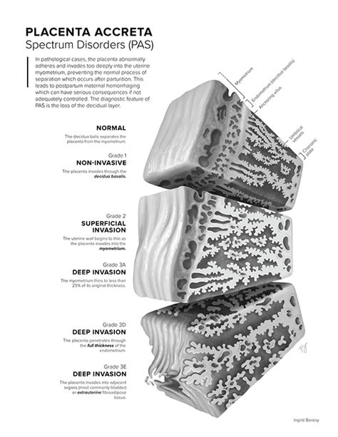 Placenta Accreta Spectrum Disorders On Behance