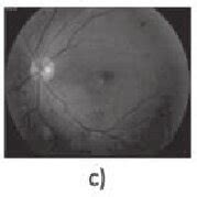 Fundus images: a) Normal or NDR, b) Mild NPDR, c) Moderate NPDR, d ...