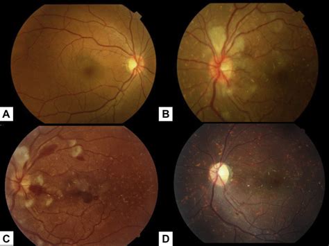 Case 2 A Fundus Photography Of The Right Eye Showing A Relatively Download Scientific