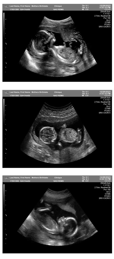 14 Weeks Pregnant Ultrasound Ultrasounds