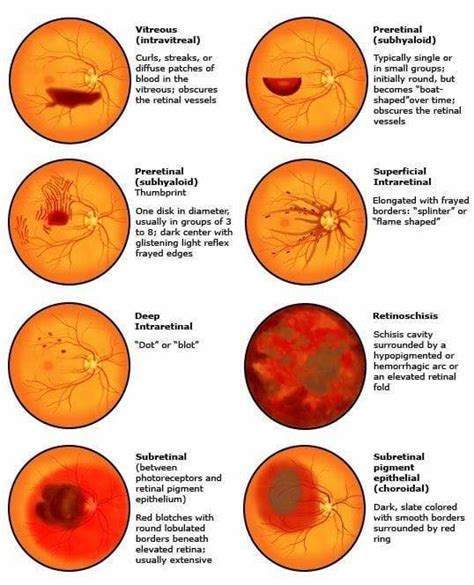 Different Types Of Ophthalmology Notes And Synopses