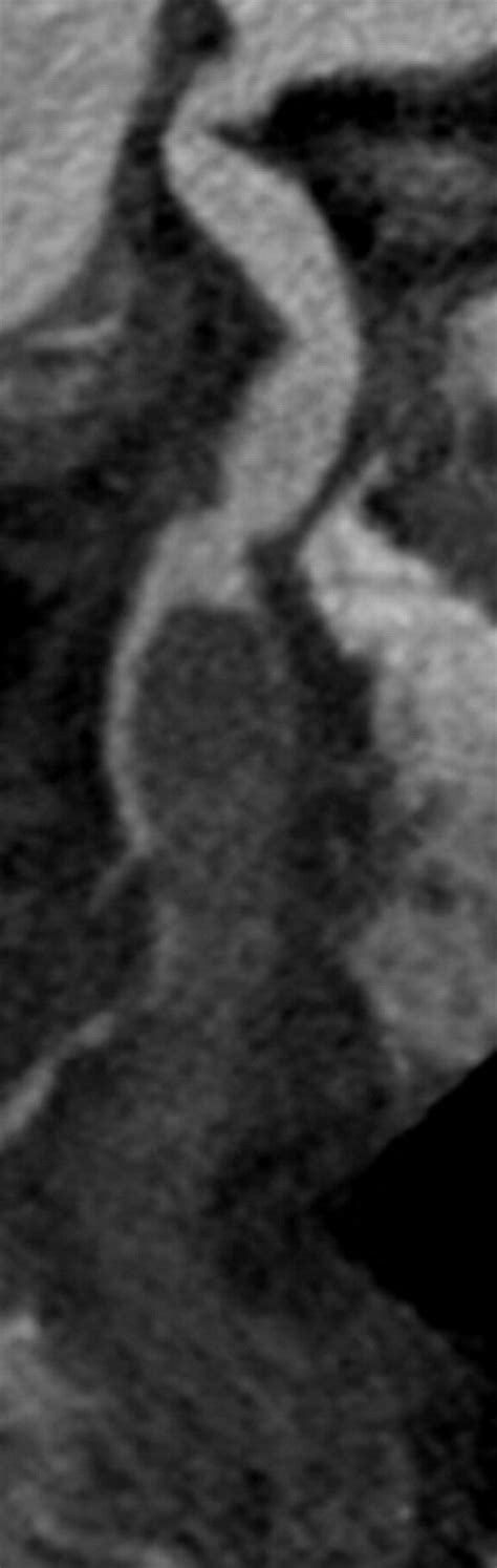 Coronary Artery Aneurysms And Ectasia Role Of Coronary Ct Angiography