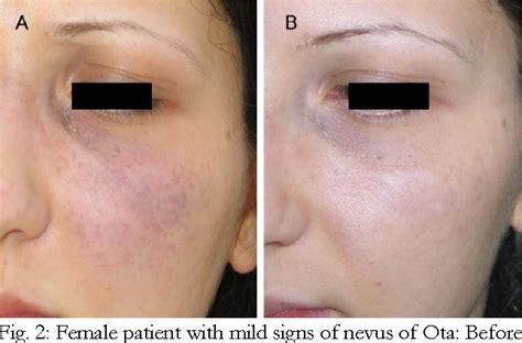 Treatment Of Nevus Of Ota With 1064 Nm Q Switched Nd Yag Semantic