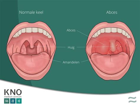 Keelabces Peritonsillair Abces KNO MEDISCH CENTRUM