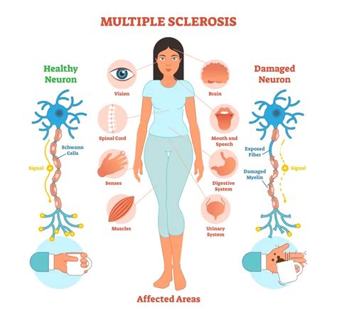 12 Signs and Symptoms of Multiple Sclerosis in Women – ActiveBeat ...