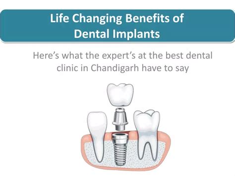 PPT Life Changing Benefits Of Dental Implants Lifecare Dental