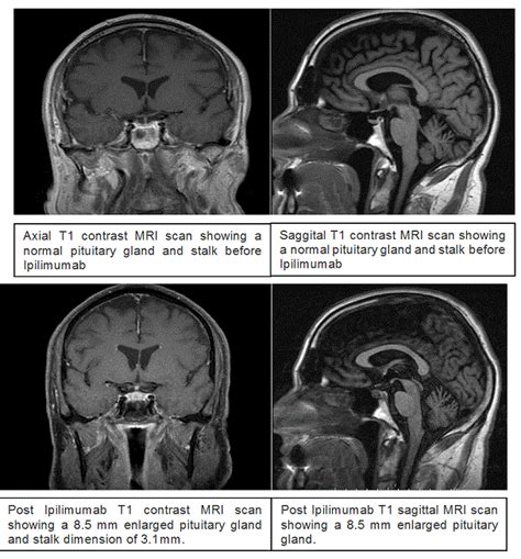 Ipilimumab Causing Autoimmune Hypophysitis : A Case Report || Endocrinology, Diabetes and ...