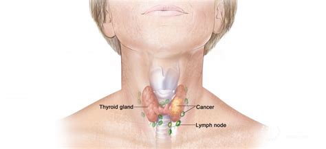 Thyroid cancer surgery: types of surgical treatment, prevention