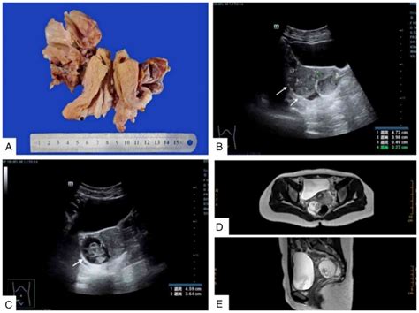 Synchronous Small Cell Neuroendocrine Carcinoma Of The Cervix And