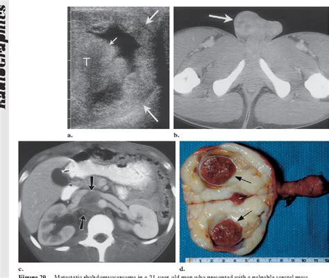 From The Archives Of The Afip Extratesticular Scrotal Masses Radiologic Pathologic Correlation