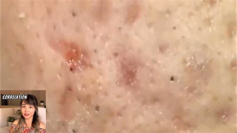 Best Blackhead And Cyst Popping 2024 Youtube