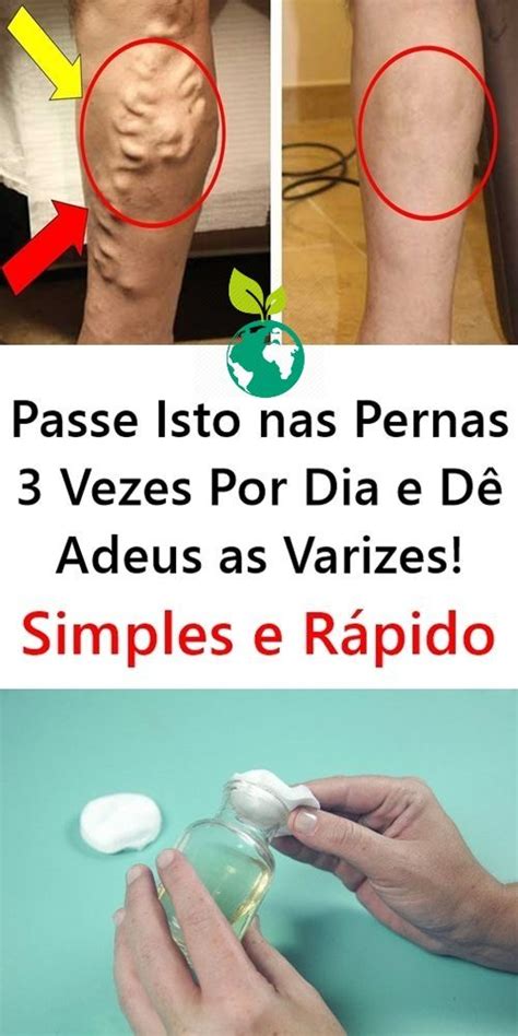 Receita Caseira Para Eliminar As Varizes Das Pernas D17