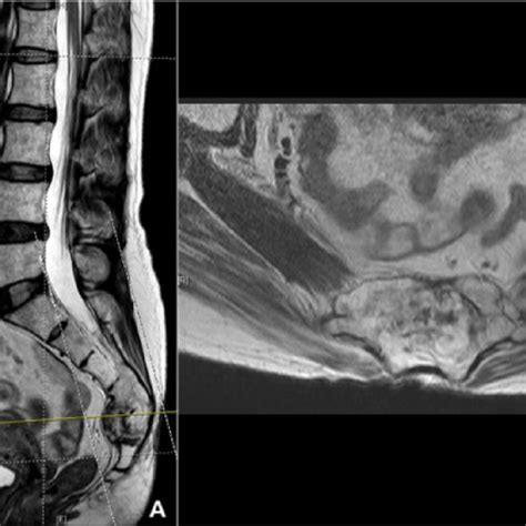 Sacral Chordoma In Magnetic Resonance Image A A T Weighted Lumbar