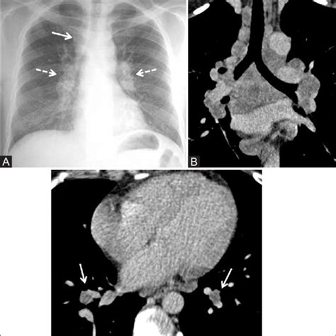 A C Tuberculosis Typical Mediastinal Lymphadenopathy A Chest Download Scientific Diagram