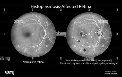 Illustration Of A Retina Affected By Presumed Ocular Histoplasmosis