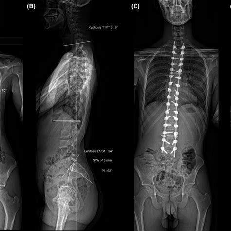 Anteroposterior And Lateral Radiographs Of The Patients Before A And