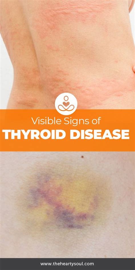 Skin Signs Of Thyroid Disease Thyroid Disease Thyroid Problems