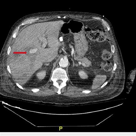 Axial View Hepatic Artery Pseudoaneurysm Seen On CTA Abdomen Red Arrow