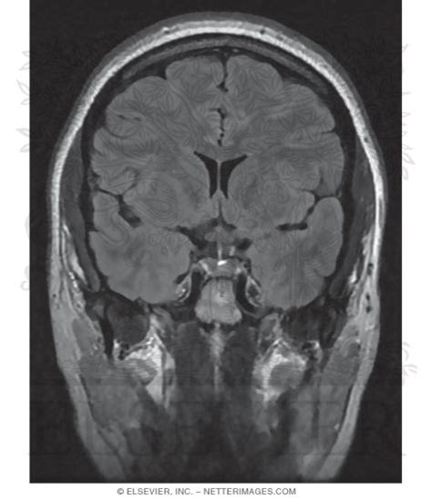 T2 FLAIR Coronal MRI Through the Optic Chiasm