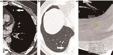 A Complete Calcified Nodule Is Considered As Benign On A Transverse